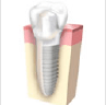 インプラント治療